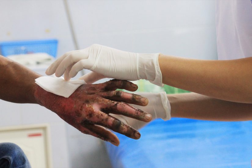 Burn Injury Lawsuit Settlements Image for Burn Injury Lawsuit Settlements post