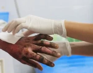 Burn Injury Lawsuit Settlements