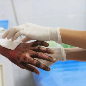 Burn Injury Image